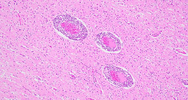 Photomicrograph showing encephalitis