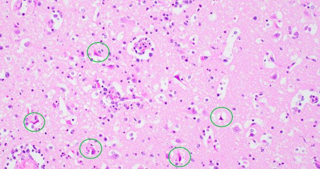 Photomicrograph showing necrotic neurones