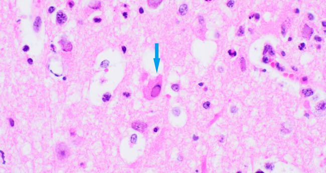 Photomicrograph showing intranuclear viral inclusion body