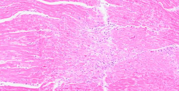 Photomicrograph of lamb heart tissue with marked myocardial degeneration