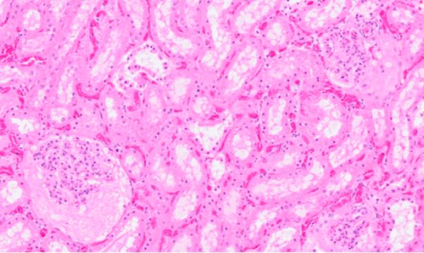 Photomicrograph of lamb kidney tissue with tubular degeneration