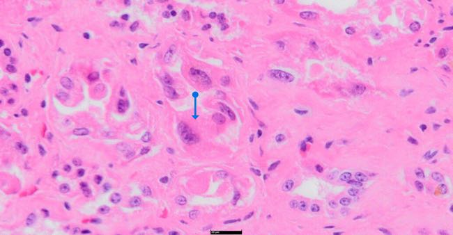 Photomicrograph of bovine kidney showing tubular injury with megalocytosis