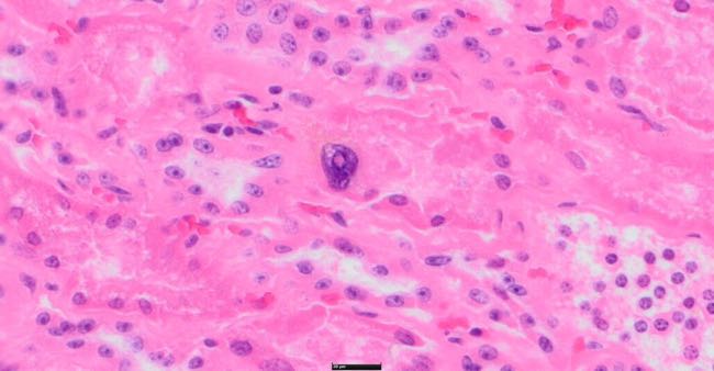 Photomicrograph of bovine kidney showing tubular necrosis with magalocyte with intranuclear inclusion