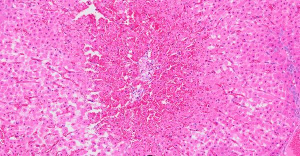 Photomicrograph of ovine liver showing necrosis and haemorrhage